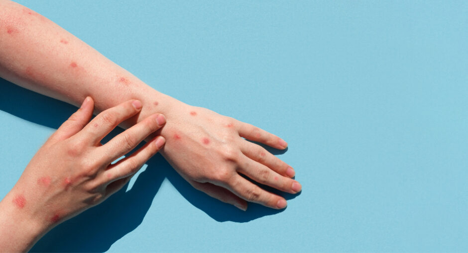 bare arms presenting Monkeypox Mpox rash blisters