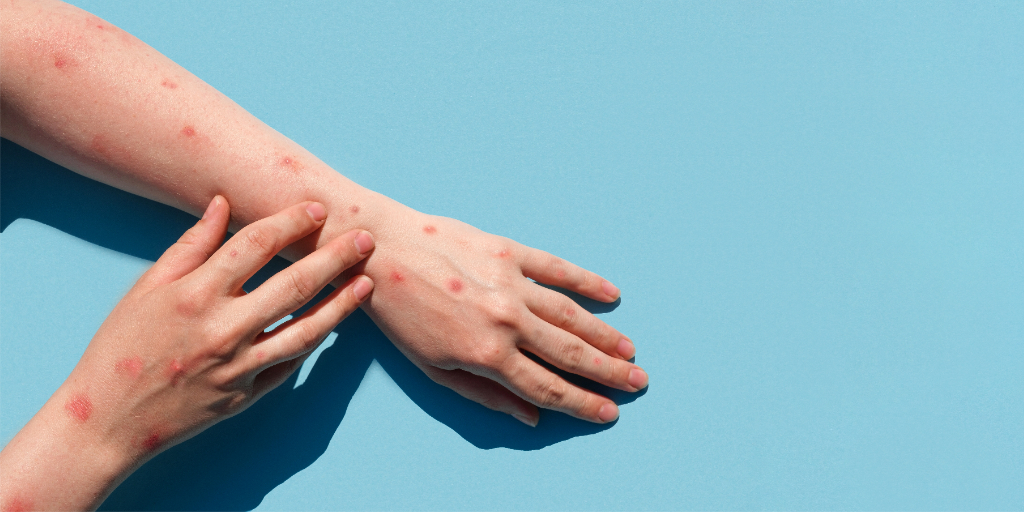 bare arms presenting Monkeypox Mpox rash blisters